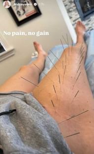 Lindsey Vonn undergoing needle therapy (Source: @lindseyvonn/Instagram)